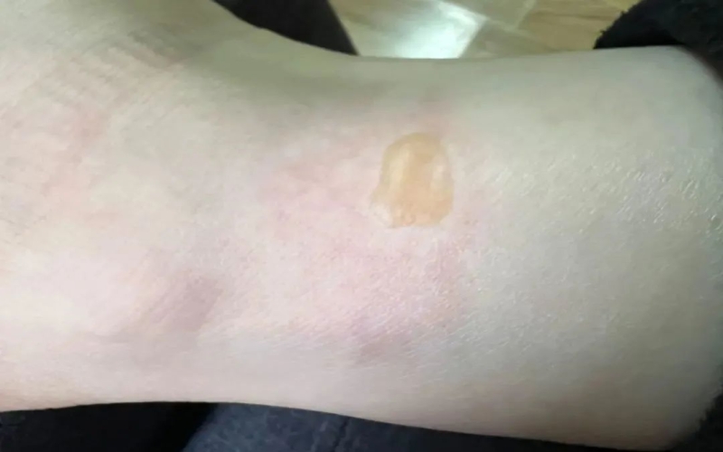 抱着热水袋睡觉，10岁小孩被烫伤！收好这份冬季取暖指南